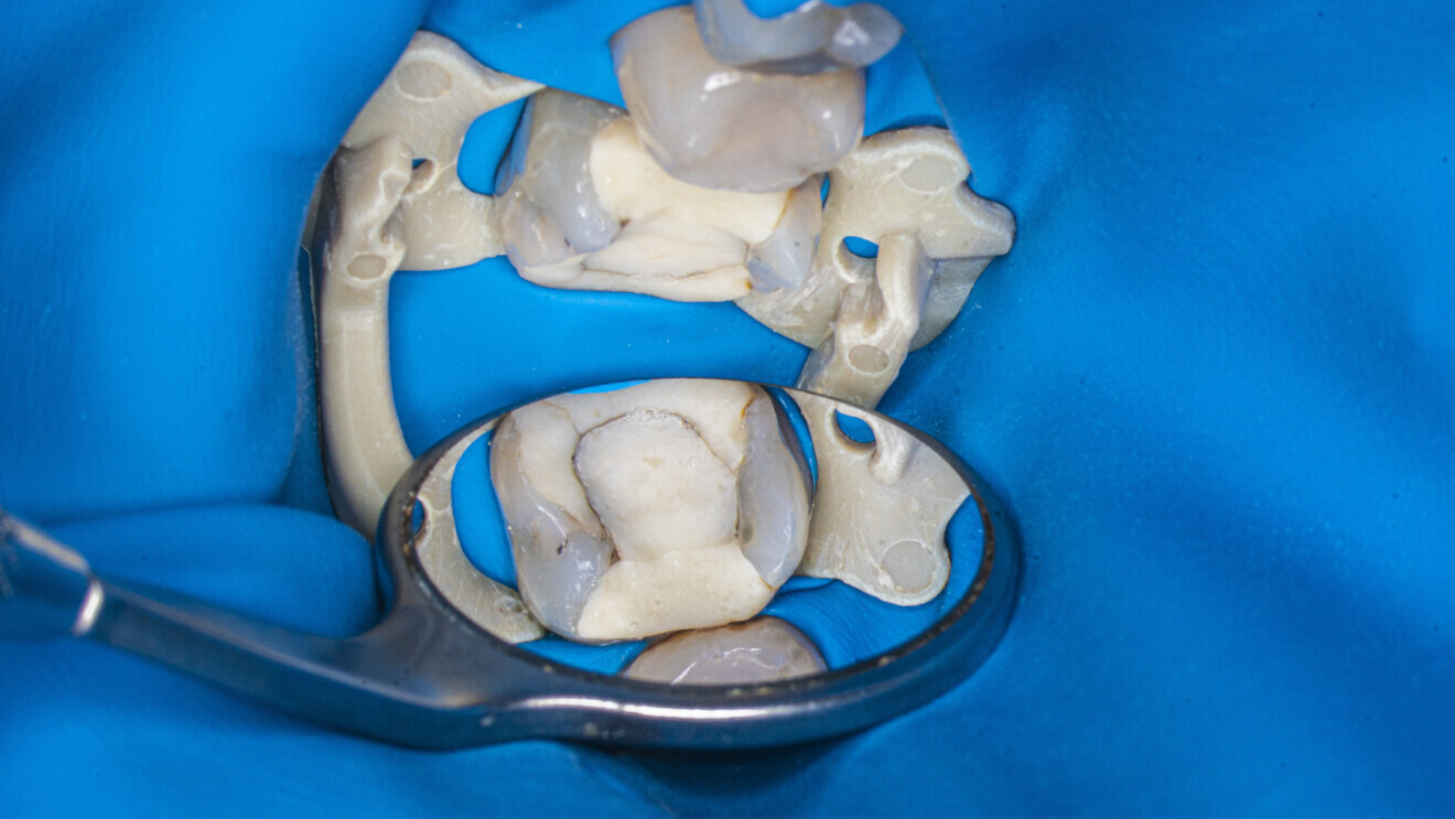 Fig. 28: Treated tooth after dental dam isolation.