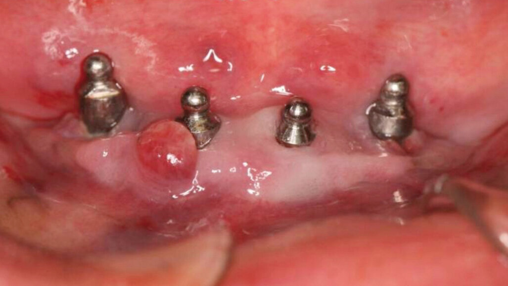 Péri-implantites et laser Er:YAG