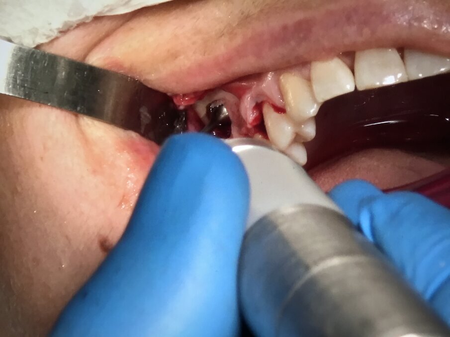 Fig. 16 - Sinus lifting: elevazione membrana Schneideriana con Piezosurgery.