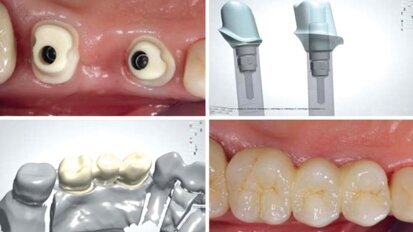 Łączniki indywidualne w odcinku bocznym