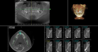 Platelets Rich Fibrin (Prf)–horizontal reconstruction of atrophic alveolar ridges, myth or reality?