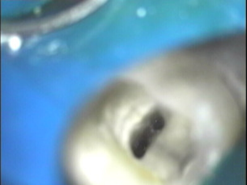 Fig. 3: Canal profile under the microscope.