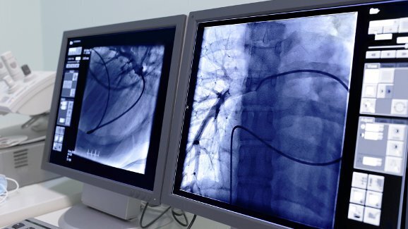 高危人群的定期肺癌CT扫描有助于头颈部癌症的早期诊断