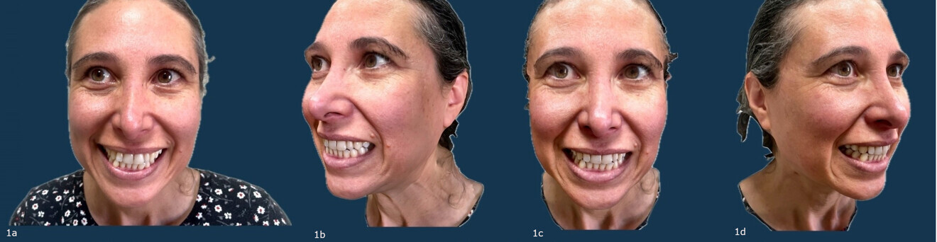 Figs. 1a–d: Comparison of a 2D photograph (a) and 3D face scanning, specifically regarding the various angles it captures (b–d).