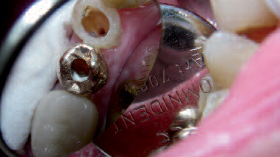 Kořen ve tvaru písmene S – rizika této velké výzvy v endodoncii