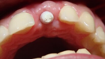 Implantoprotetyczne odtworzenie brakującego zęba 21 – opis przypadku