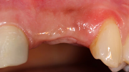 Use of a decalcified cortical bone plate to aid in lateral ridge augmentation