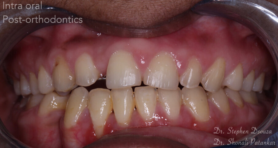 Fig. 4: Intra-oral view, post-orthodontics.