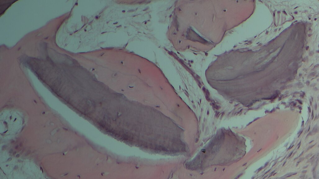 Aumento della cresta alveolare con tecnica “Bone into Bone”: analisi istomorfometrica