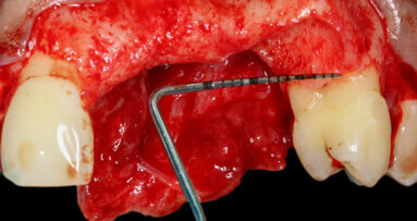 How to use Straumann biomaterials—an overview for dental students
