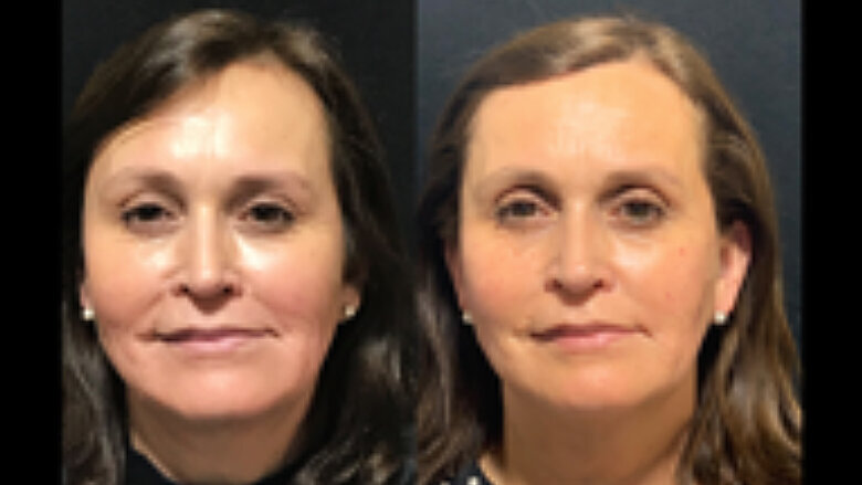 Foto 6. Paciente al día 21 (izquierda) y control a los 7 meses (derecha). Se observa la reaparición de arrugas faciales estáticas, pero de menor profundidad y cantidad que en foto 1. Se planifica re-aplicación de toxina botulínica, mejoramiento de ojo hueco y aplicación de hilos de revitalización PDO y de sustentación o tensión Silhouette Soft.
