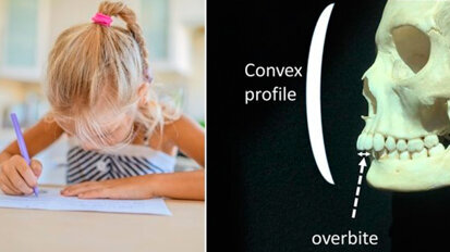 Uno studio conferma il collegamento tra volti scavati e mancinismo