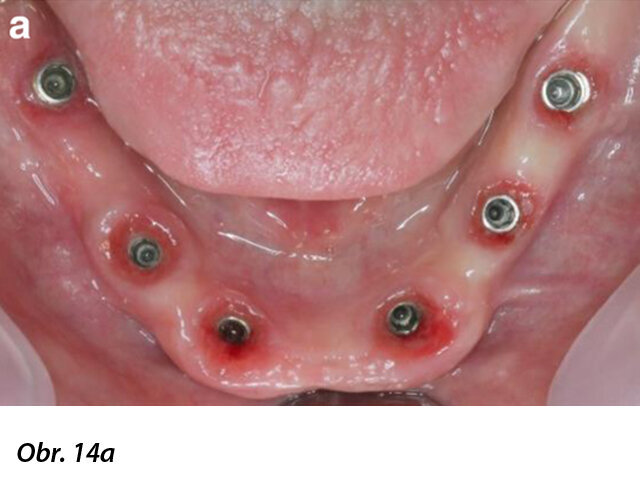 Zdravý stav periimplantátové sliznice a finální CAD/CAM náhrada bezprostředně po nasazení pacientce.