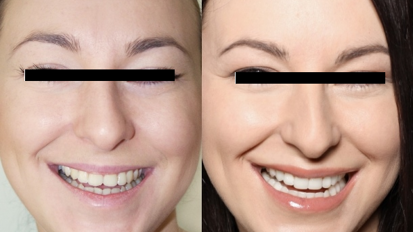 Bonding – sposób na udoskonalenie uśmiechu