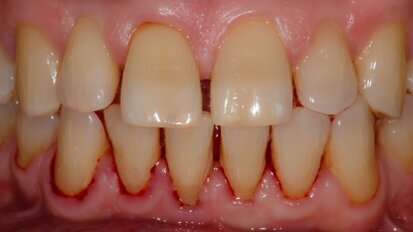 The intersection of technology: Guided implant surgery and 3D printing