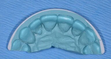 Improving success with your cosmetic cases using the TMJ QuickSplint