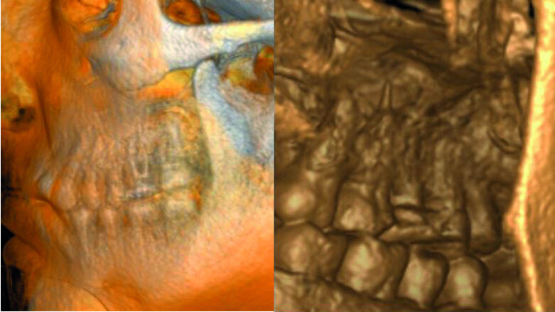Maxillary sinus and root canal therapy complications