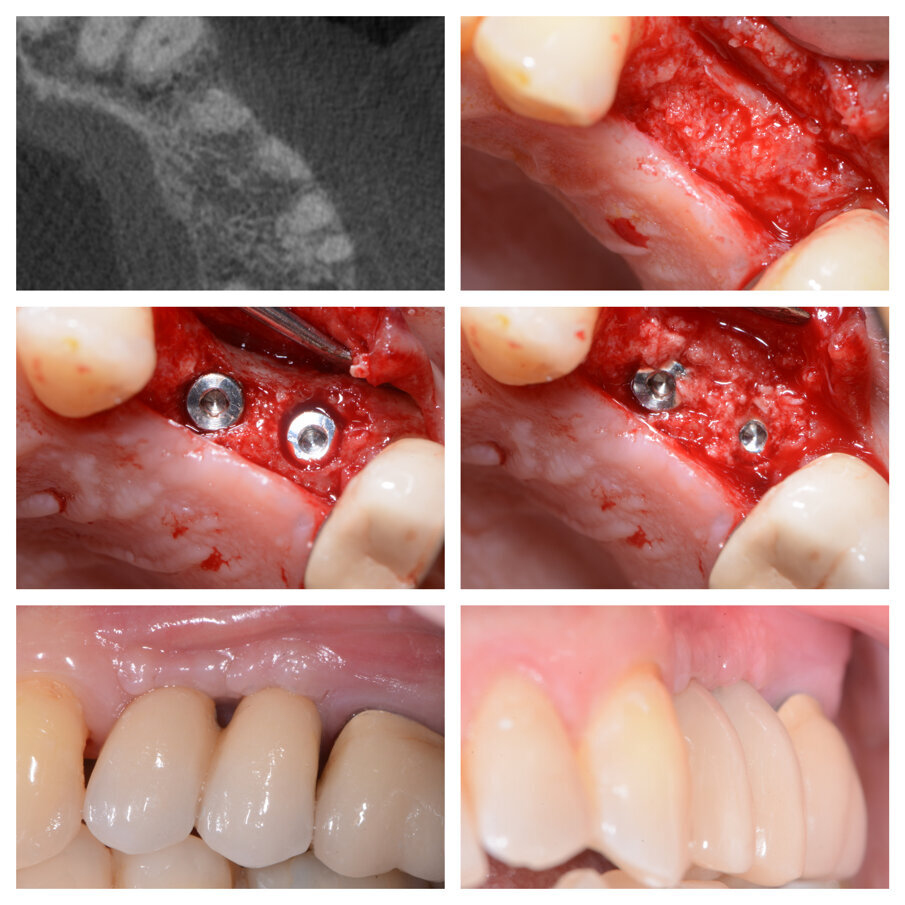 Fig. 6b_Rientro chirurgico per il posizionamento implantare e protesi definitiva.