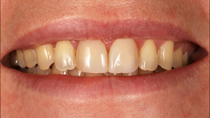 Fig. 4. El mock-up satisfizo las expectativas estéticas de la paciente. Fig. 4. El mock-up satisfizo las expectativas estéticas de la paciente.