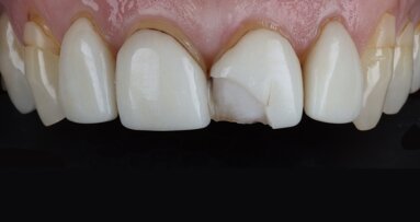 Glass-ceramic veneer cementation: Full adhesive workflow with PANAVIA Veneer LC