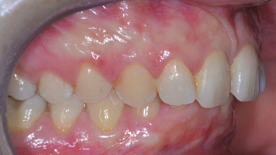 Figg. 4d-4f_Foto intraorali di inizio trattamento.