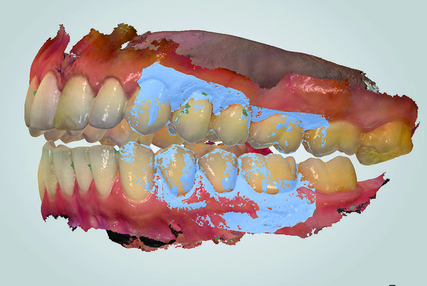 Fig. 18: TRIOS 3 software (3Shape) matching digital casts of arches to side view inter-arch scan (in light blue).