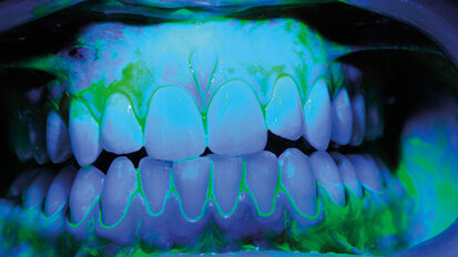 White spot: protocollo operativo di tailoring domiciliare e professionale. Case report