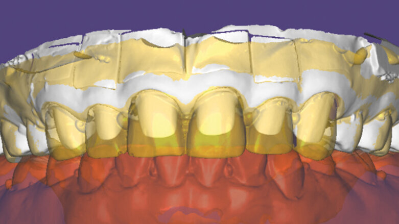 Zkratka po rychlé digitální dráze: Přesná reprodukce provizorních náhrad s IPS e.max Press® Multi