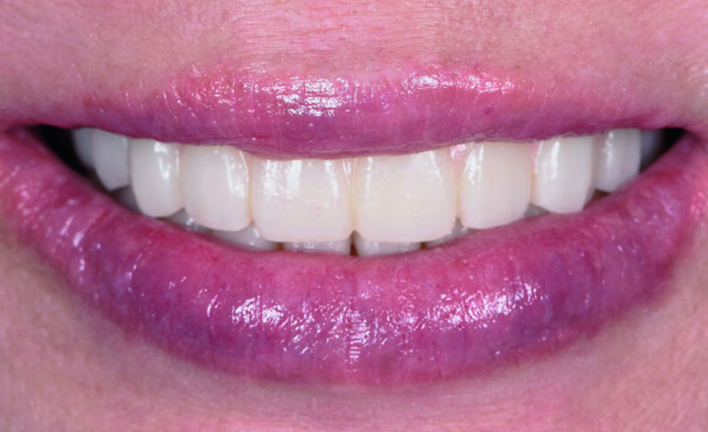 Fig . 26. Post-operative smile with provisional profile prosthesis