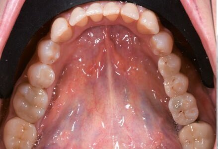 Fig. 17 - Consegna del manufatto protesico.