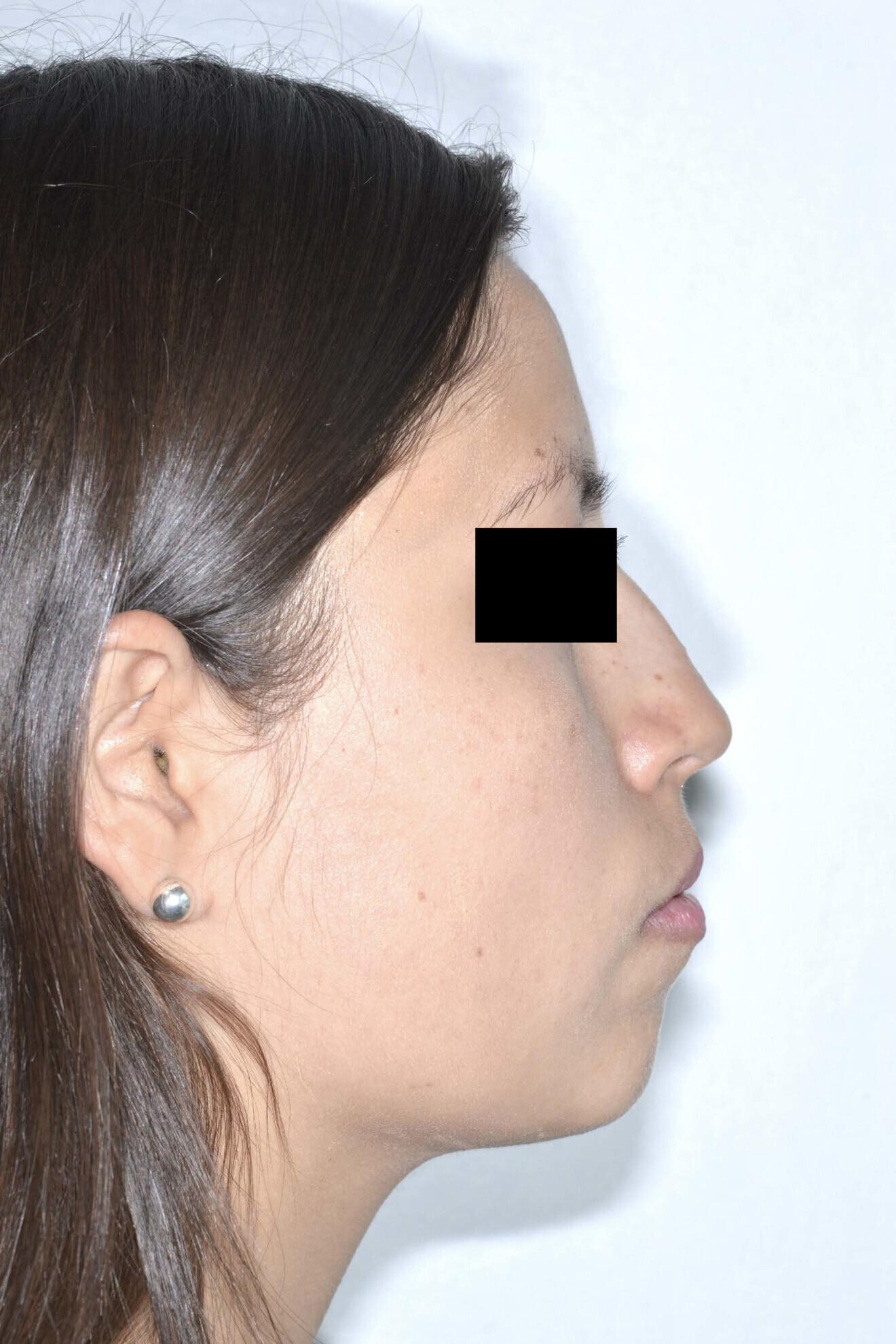 Fig. 1c: Initial extra-oral photographs.
