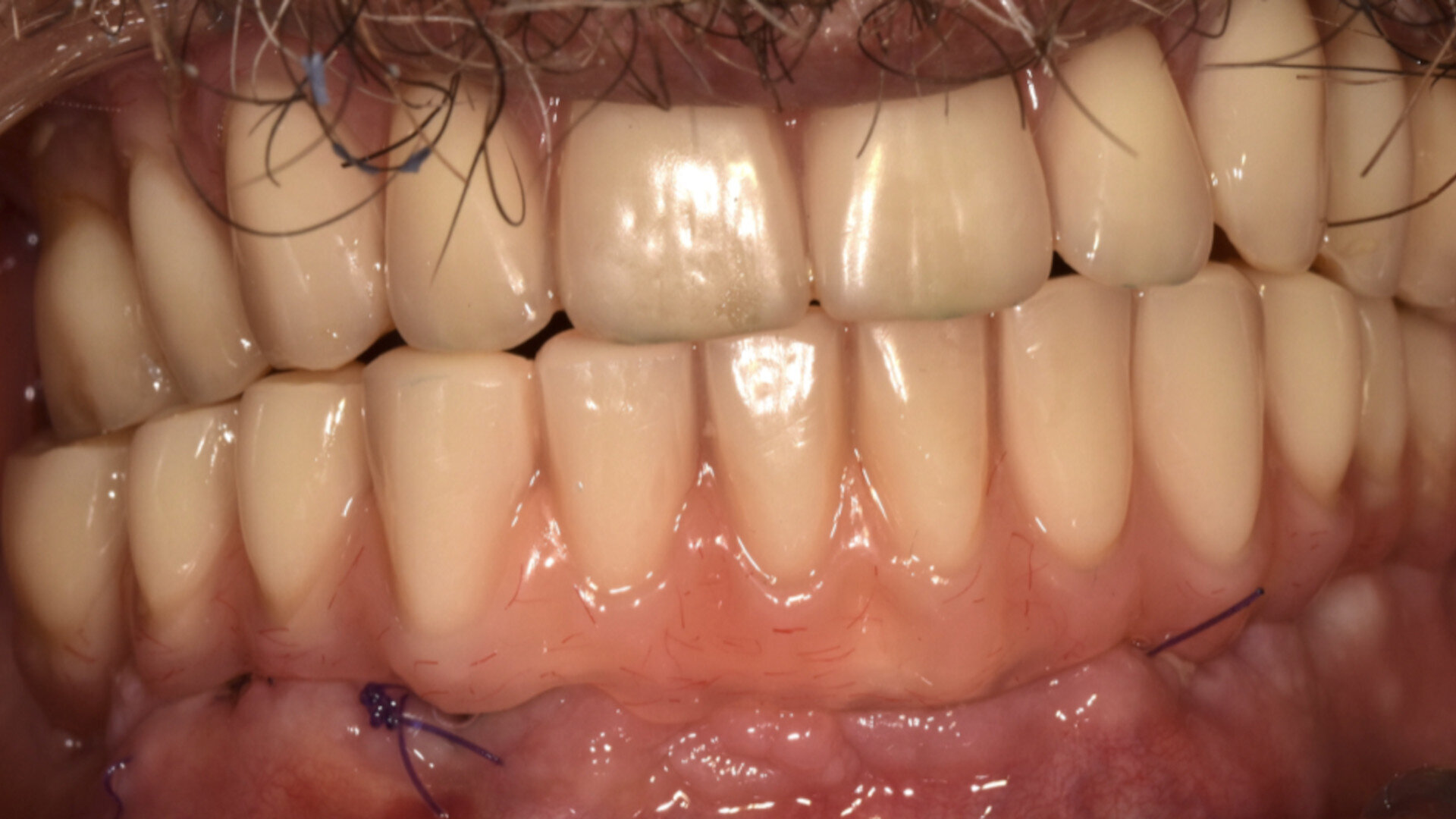 De nouveaux matériaux pour la prothèse sur implants