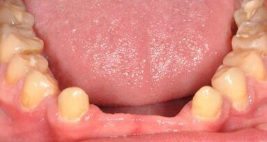 Leczenie ortodontyczne i implantoprotetyczne u pacjentów z dysplazją ektodermalną