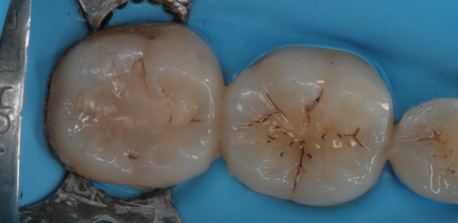 Fig. 20_Isolamento del campo operatorio.