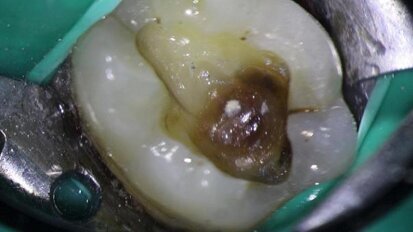 Diagnosis and management of a longitudinal fracture necrosis associated with an extensive periodontal defect