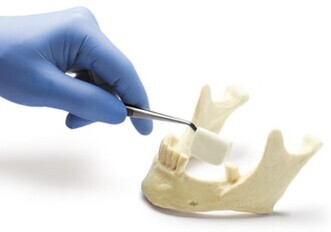 Zimmer CurV: redefining ridge augmentation