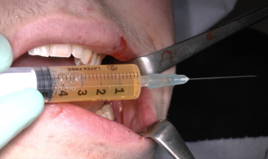 Fig. 14_Preprazione del PRF liquido.