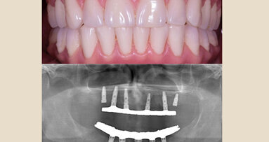 Prótesis Híbrida Inmediata en pacientes edéntulos mandibulares