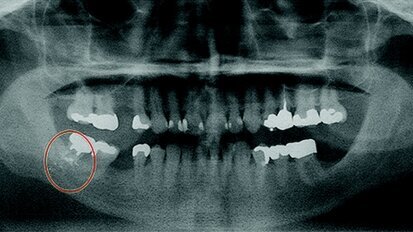 Ritrovamento di corpi estranei durante un trattamento odontoiatrico di routine