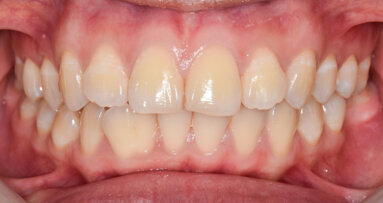 Researchers uncover how oral bacteria can affect the aggressiveness of colon cancers