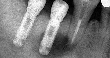 Periapikální léze implantátů a retrográdní periimplantitis – dva stavy nepříliš zdokumentované