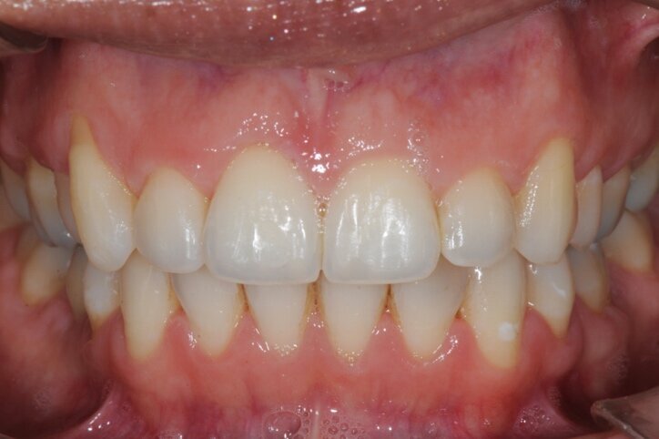 Figg. 6a-6d - Foto intraorali post-trattamento: visioni frontale (a), laterali (b), occlusali (c, d).