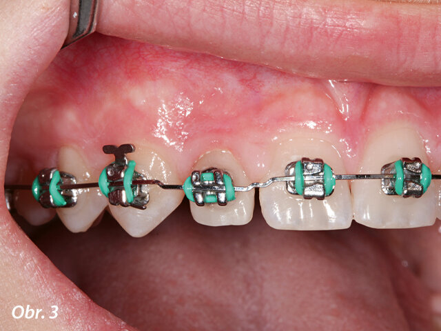 Drobné laterální řezáky u 1. případu.