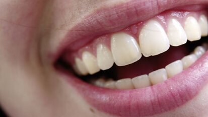 Coenzyme Q10 : une molécule naturelle améliore l’état gingival