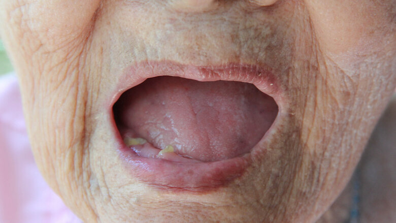 Study suggests causal link between tooth loss and heart disease