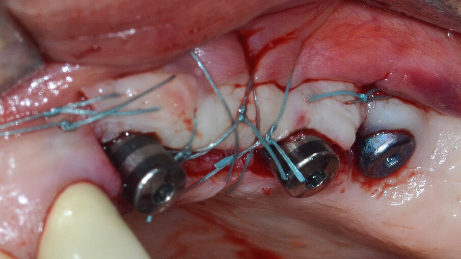 Fig. 15 - Lembo riposizionato apicalmente e suturato con punti a materassaio orizzontale incrociato e punti staccati.