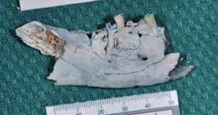 Forenzička odontologija – disciplina koja obuhvata više od identifikacije