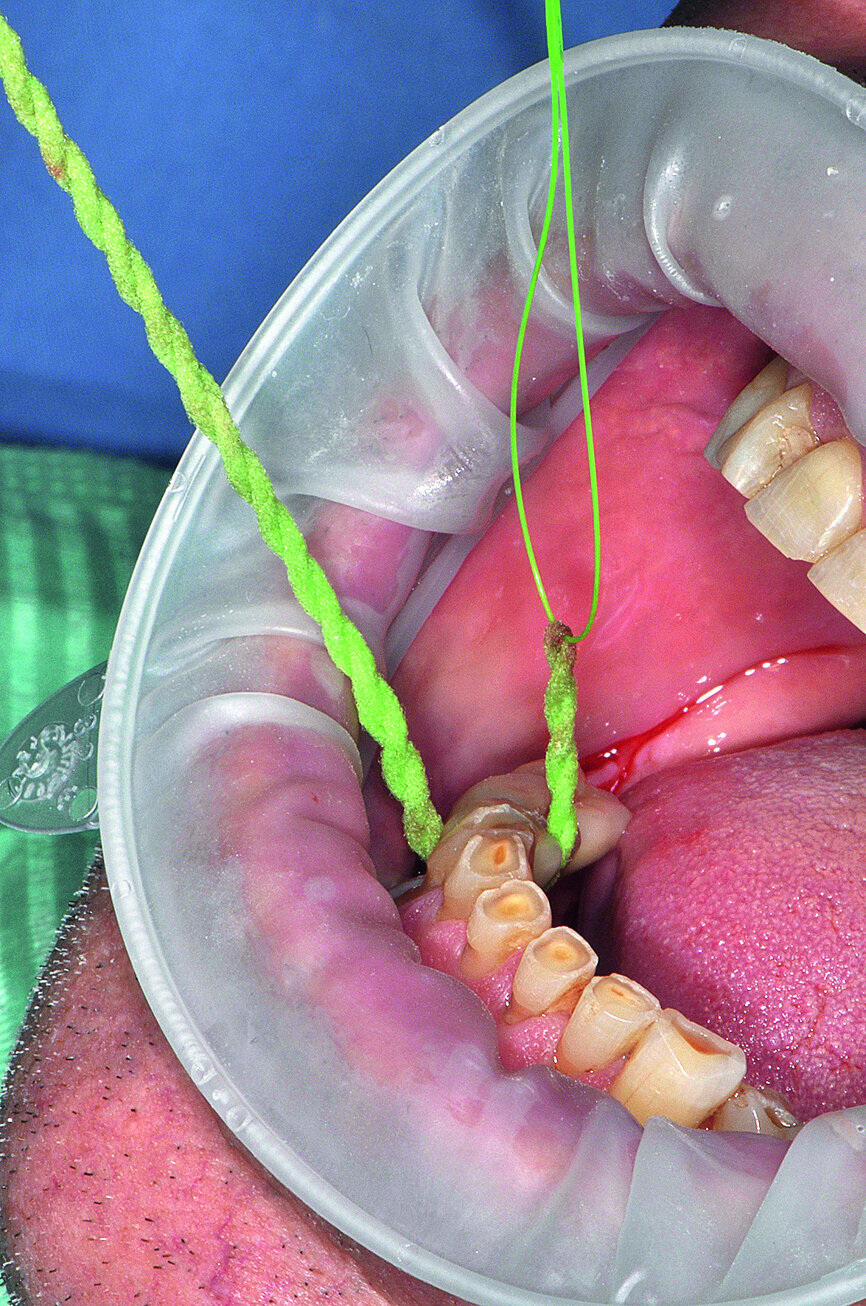 Fig. 4b: Peri-implant home care with a) AirFloss (Philips), b) X-Floss (ROEN) and c) interdental brush (TePe).
