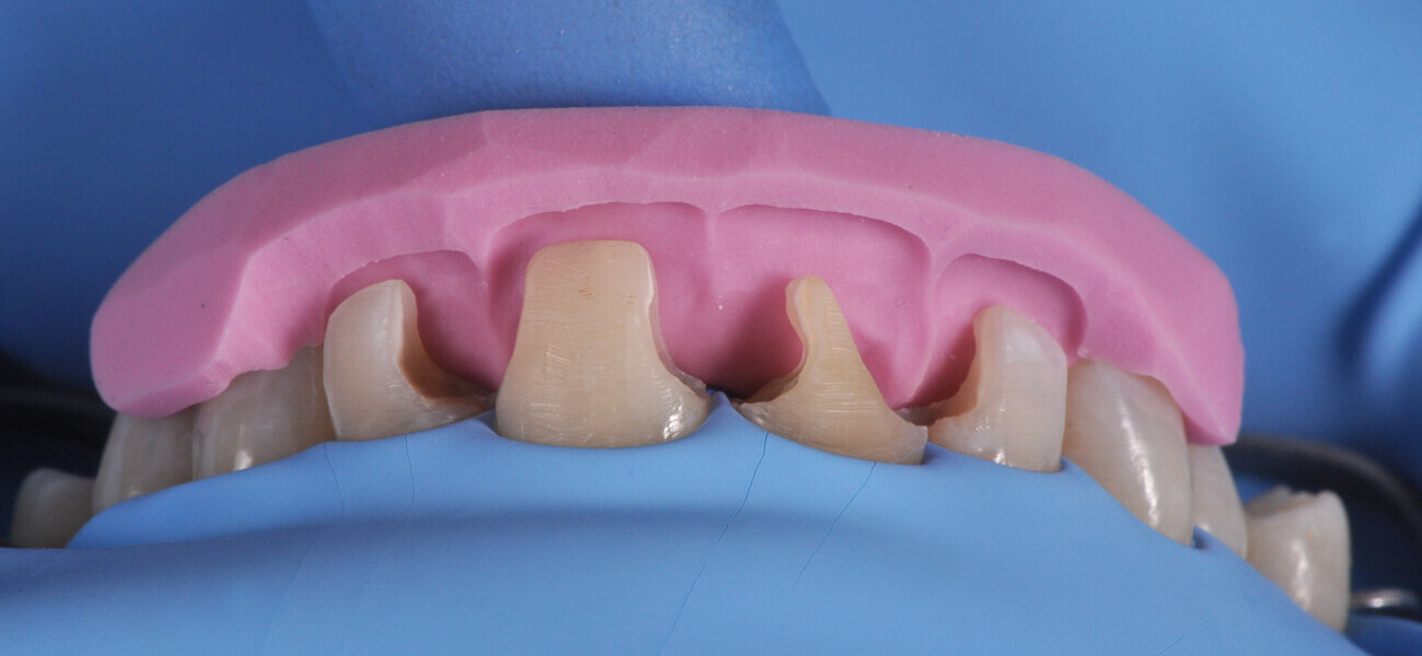 Fig. 9: Palatal silicone index positioned intra-orally for the build-up of the palatal wall.