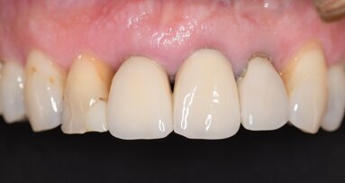 A fully guided digital workflow for predictable implant planning and placement